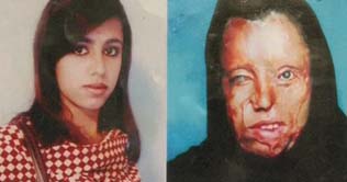 Acid victim girl yearns for justice